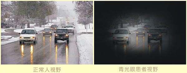 「青光眼」的圖片搜尋結果