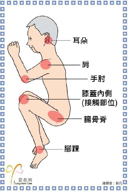 壓傷部位 