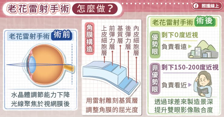 老花雷射的手術怎麼做?