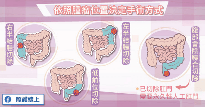 大腸癌