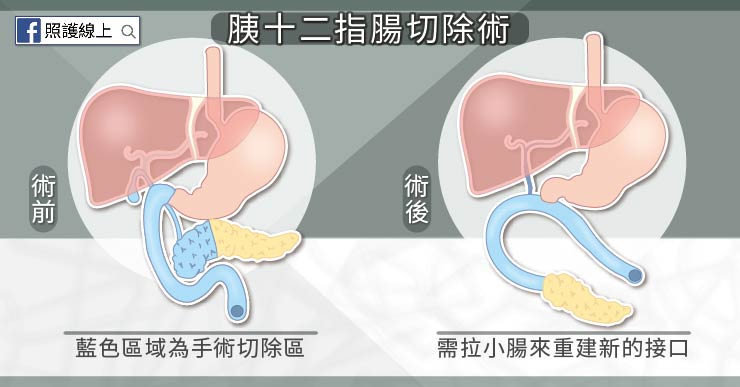 癌症