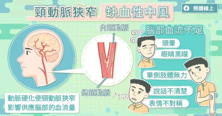中風