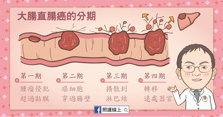 發生率第一名的癌症–大腸直腸癌(懶人包)–照護線上 大腸直腸癌
