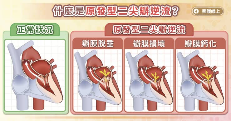 原發型二尖瓣逆流