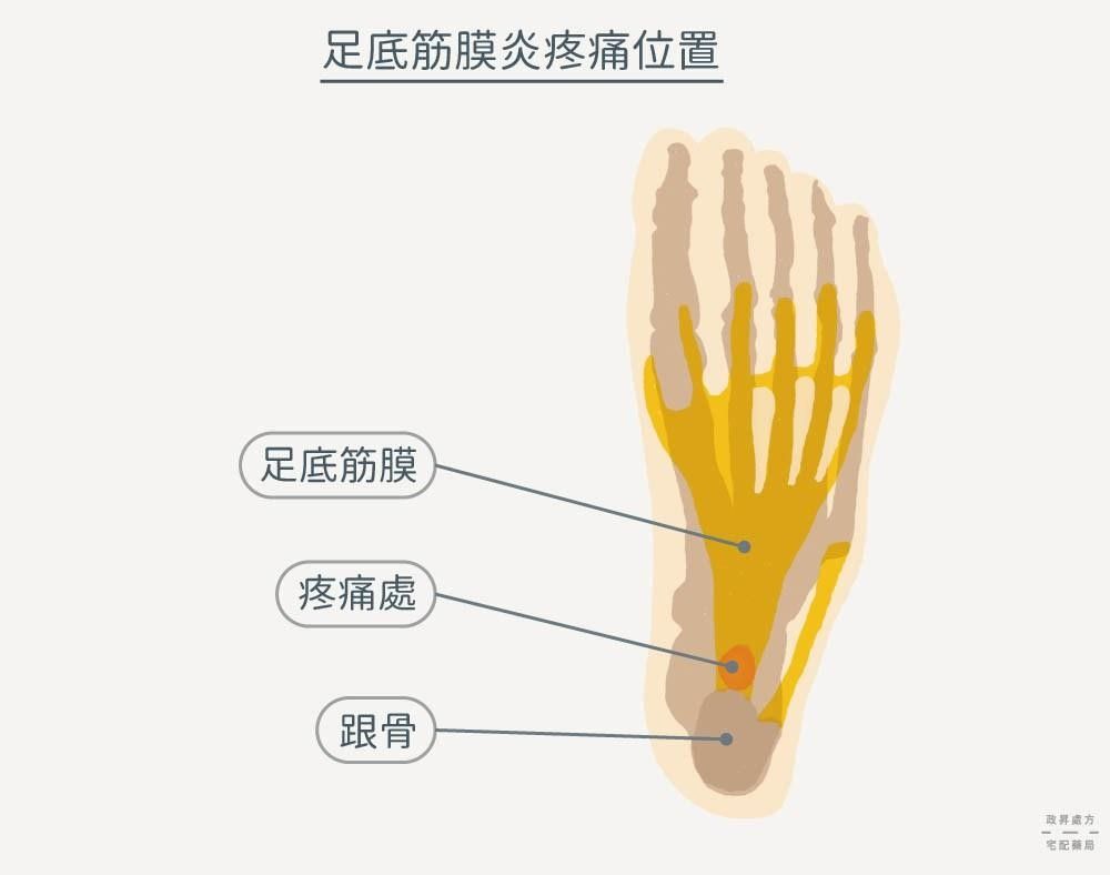 足底筋膜