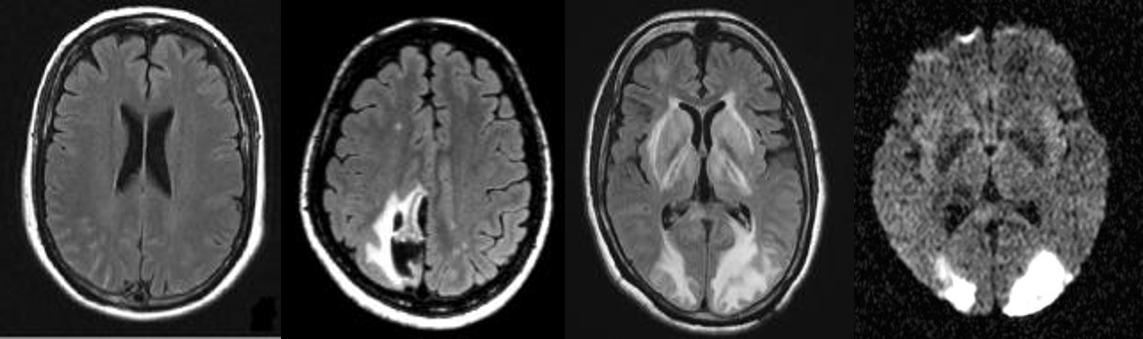 左一為正常大腦,由左至右為腦出血、腦中風及腦水腫的樣子。(圖/陳世彬提供)
