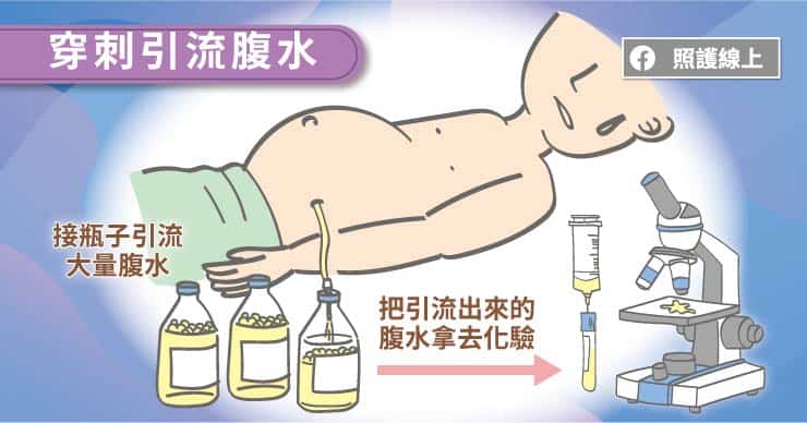 腹水