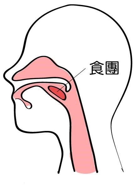 吞嚥困難