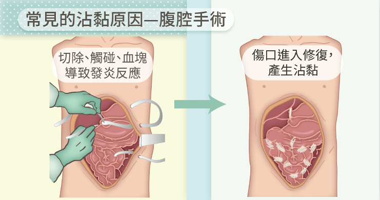 腹腔