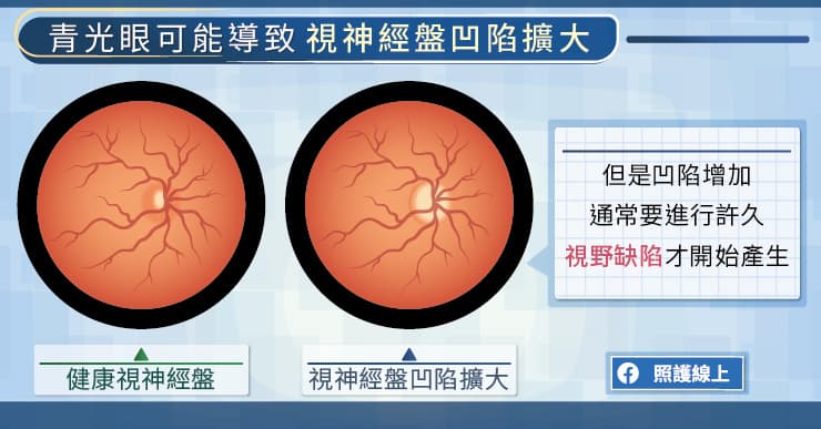 青光眼