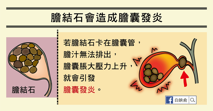 膽囊炎