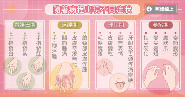 硬化症