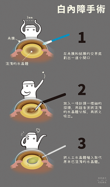 白內障手術