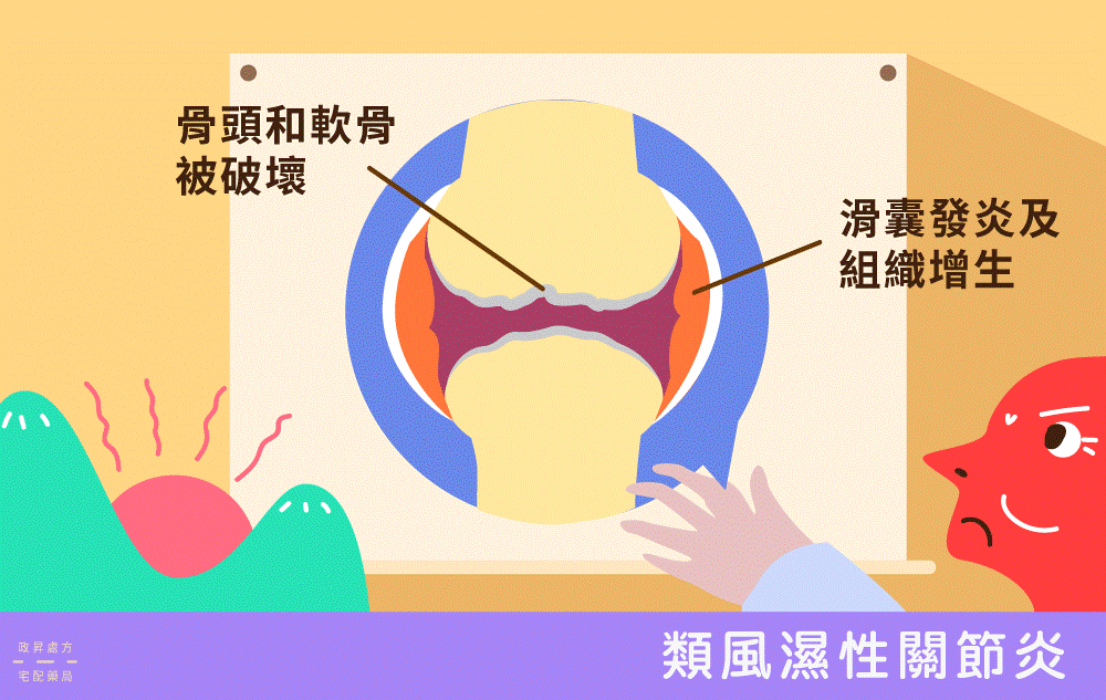 類風濕性關節炎