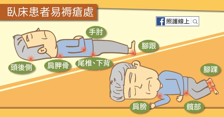 褥瘡