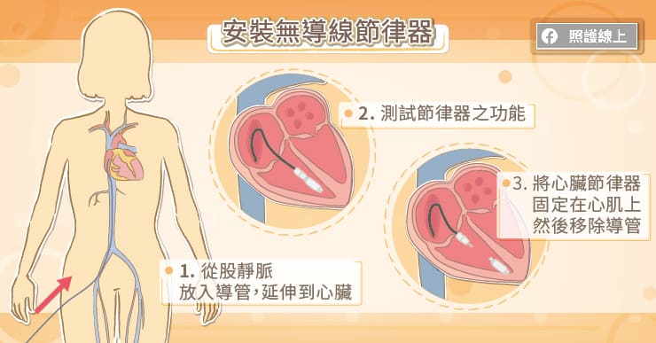 心臟