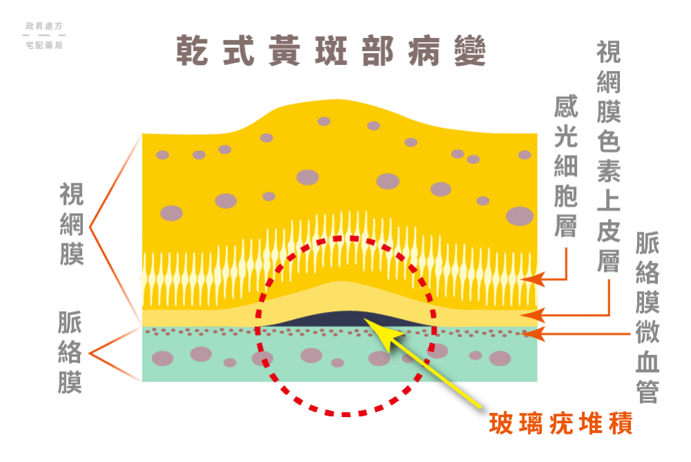 乾式黃斑部病變