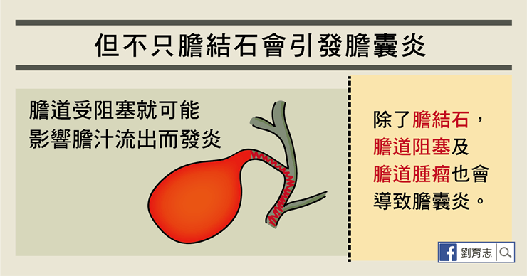 膽結石