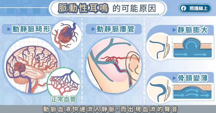 脈動性耳鳴的可能原因