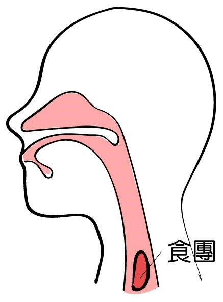 吞嚥障礙