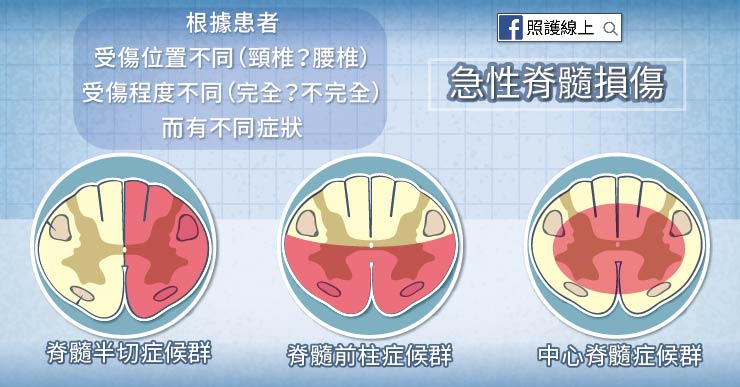 脊隨損傷
