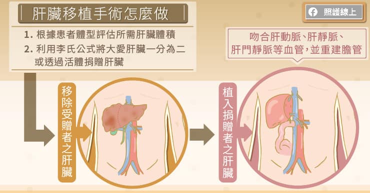 肝臟移植手術怎麼做