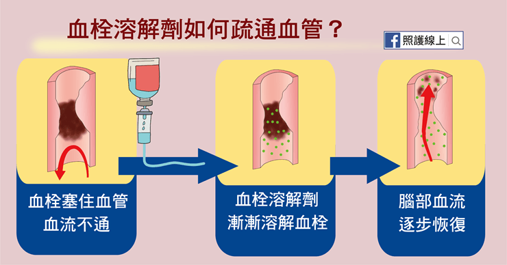 中風