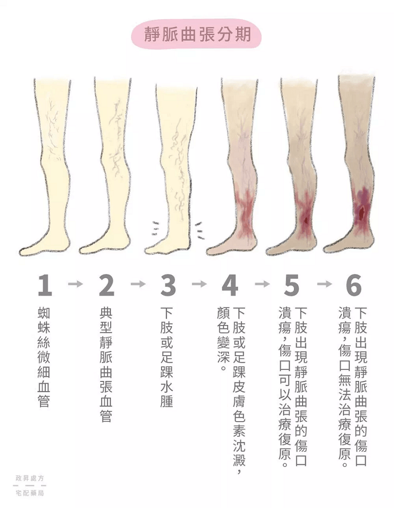 靜脈曲張