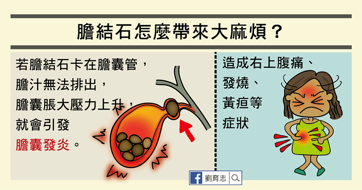 膽結石