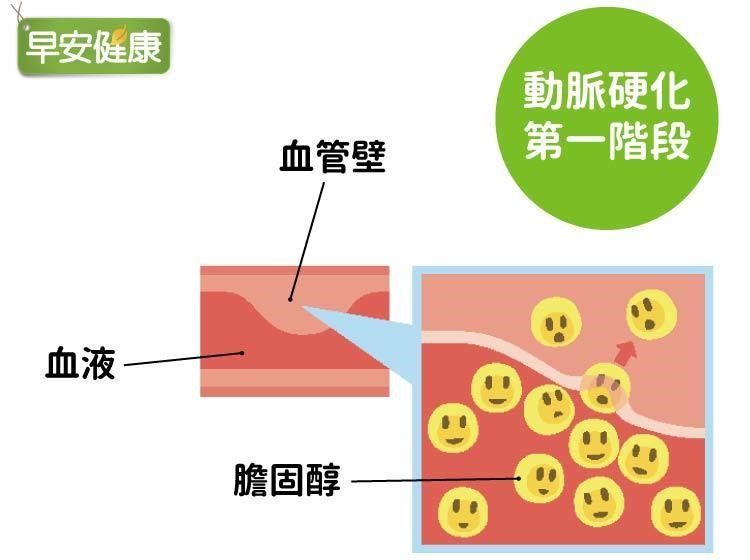 動脈硬化