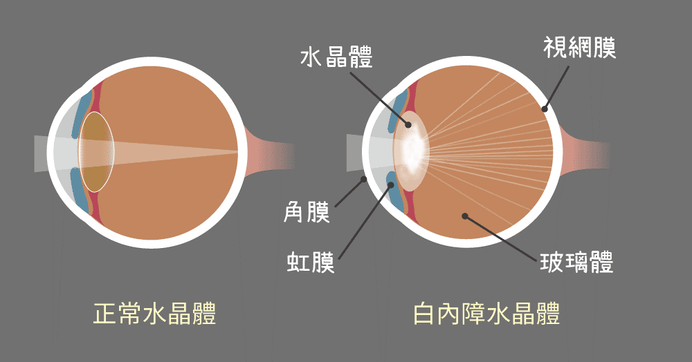 白內障