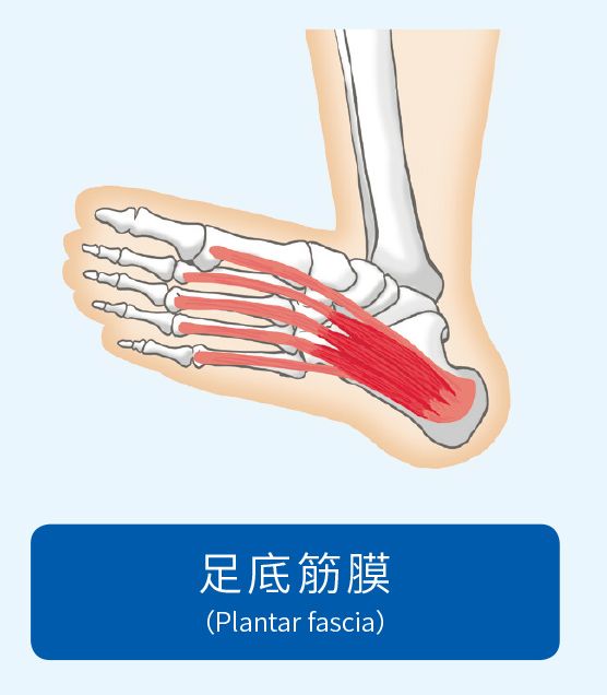 足底筋膜炎