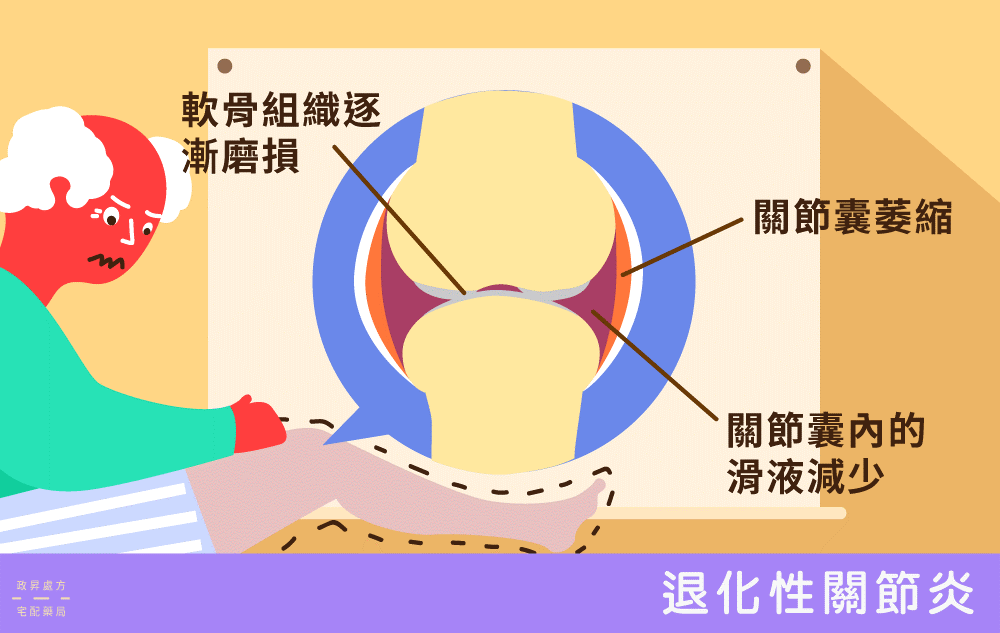 骨刺