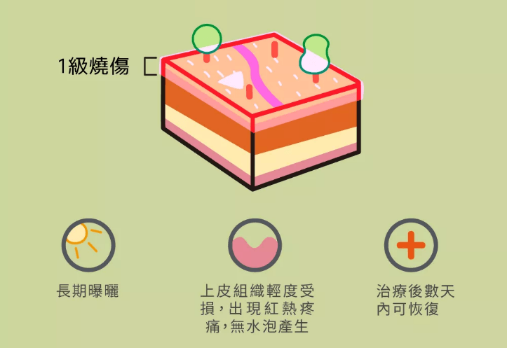 一度燒傷
