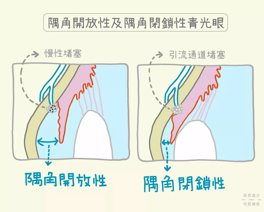 青光眼
