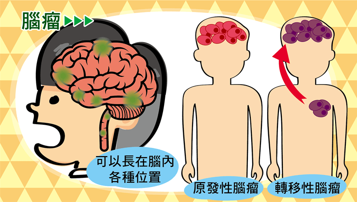腦瘤