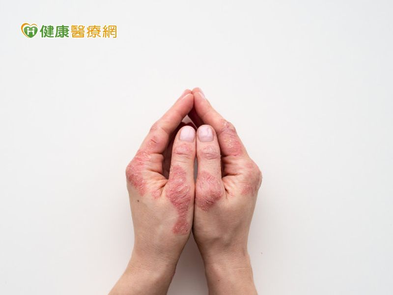 乾癬
