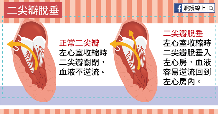 二尖瓣