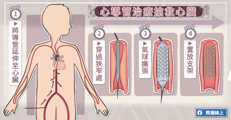 心導管