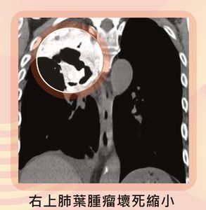 腫瘤