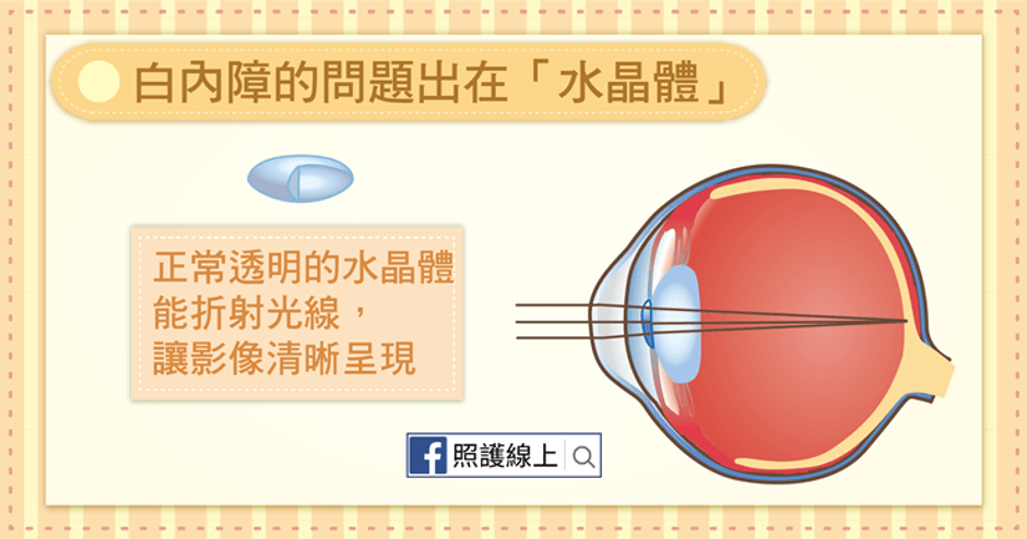 白內障