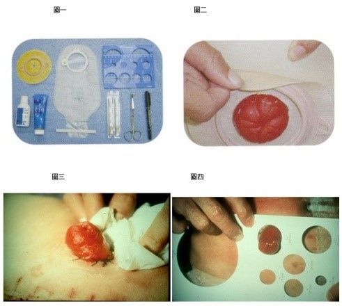 腸造口