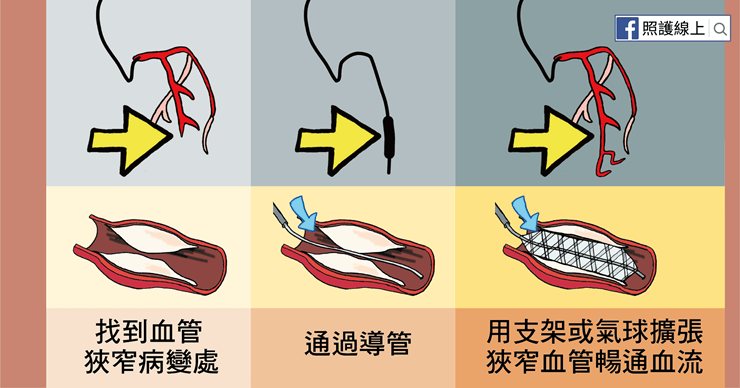 支架