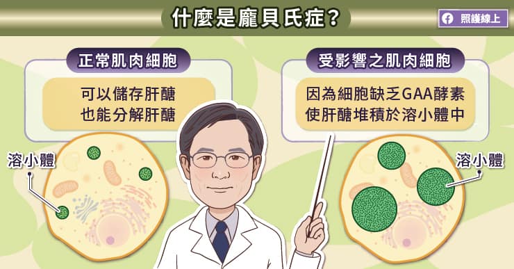 什麼是龐貝氏症?