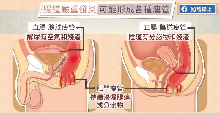 腸道