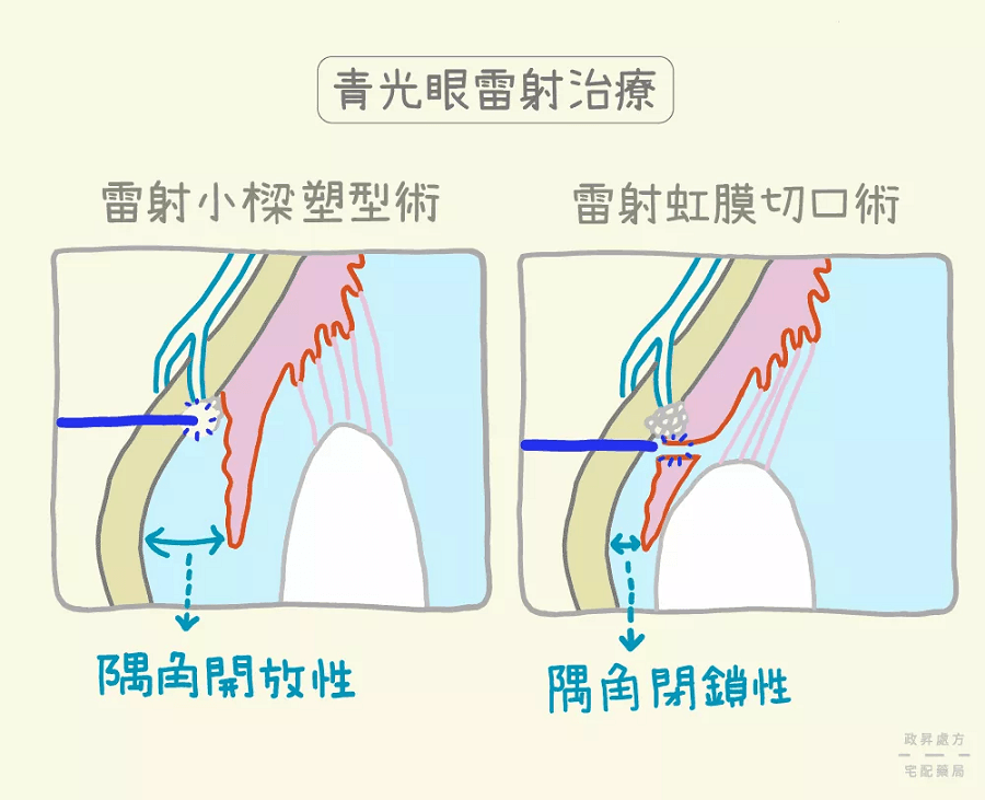 青光眼