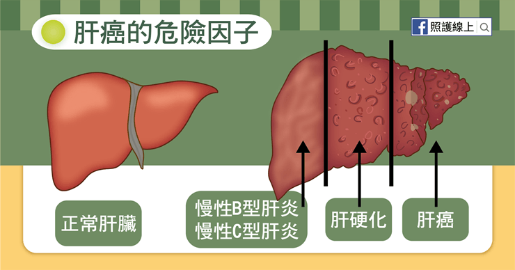 肝癌