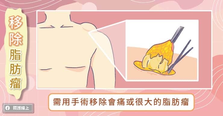 脂肪瘤