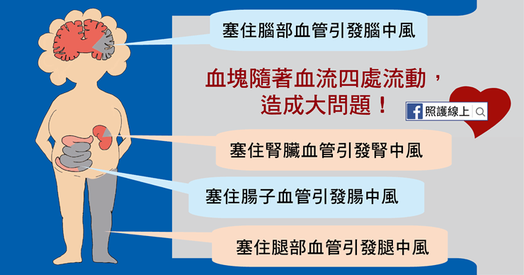 心房顫動