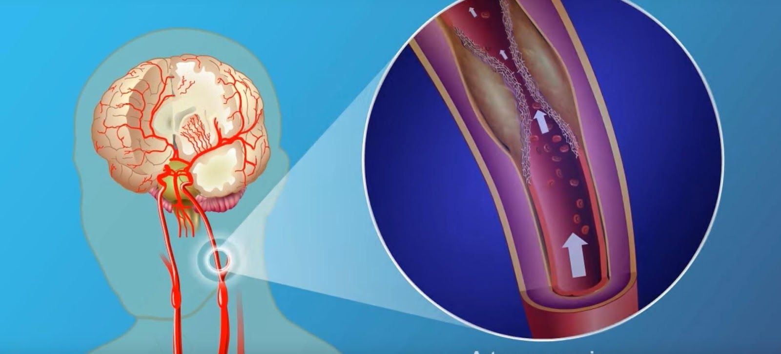 缺血性腦中風